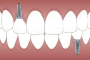 Are Tooth Implants Removable? Exploring Dental Implant Options