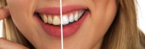 Do You Brush Your Teeth After Oil Pulling? Essential Tips
