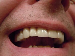 How to Remove a Tooth Crown at Home: DIY Dental Care Tips 9 How to Remove a Tooth Crown at Home: DIY Dental Care Tips